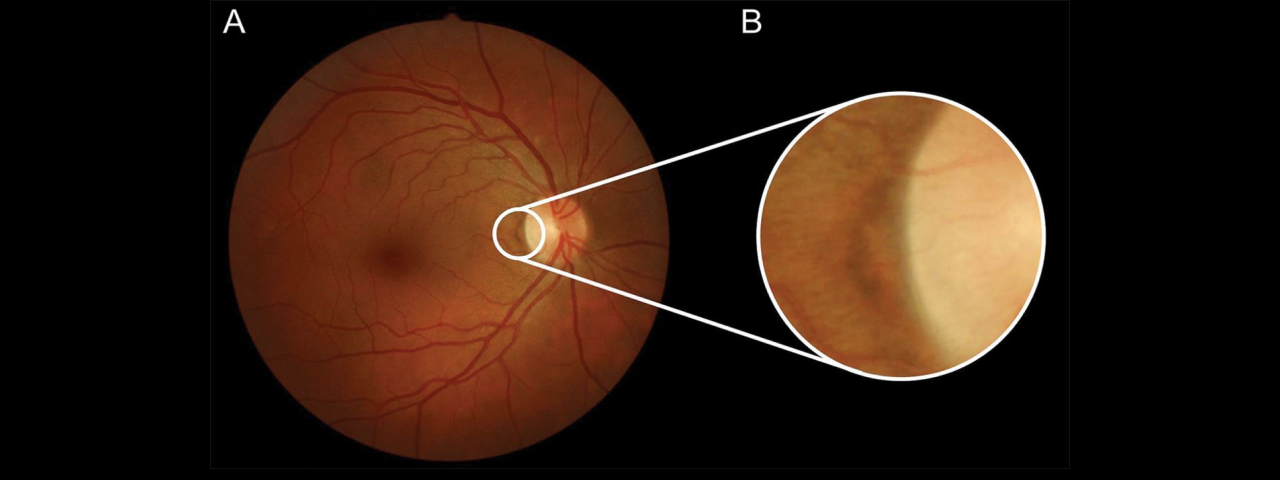 Офтальмоскопия глазного дна